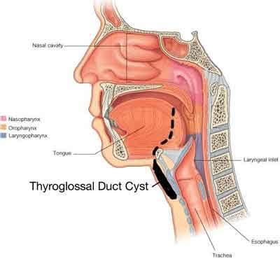 Thyroglossal Duct Cyst And Fistula Standard Treatment Guidelines