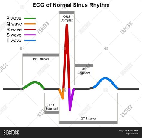 Ecg Normal Sinus Image And Photo Free Trial Bigstock