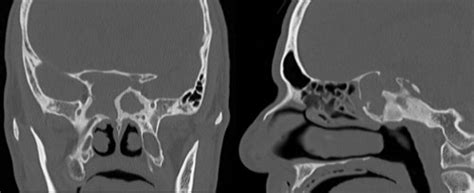 Skull Base Erosion And Associated Complications In Sphenoid Sinus Fungal Balls Josh C Meier