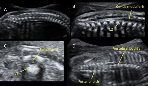 Spina Bifida 3d Ultrasound