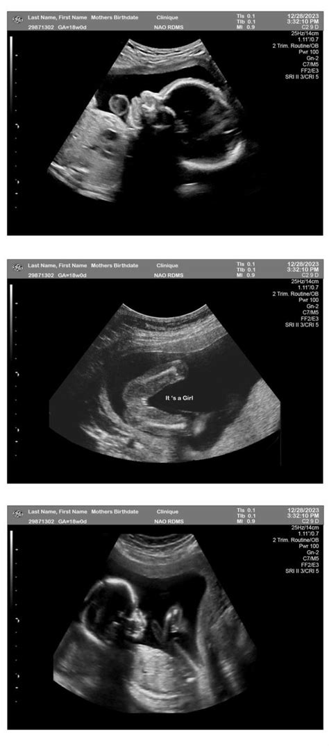 Weeks Ultrasound Girl Fetuses Ultrasounds