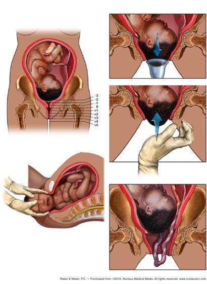 Prolapso del cordón umbilical y lesiones por compresión ABC Law Centers