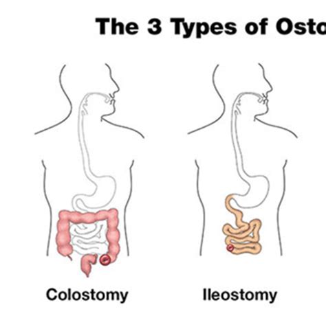 Perianal Disease And Crohns Flashcards Quizlet