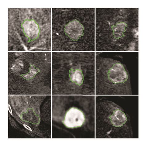 Liver Lesion Segmentations Depicted Are Central Slices Through The