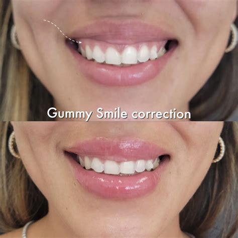 Treating A Gummy Smile With Botox The Daily Glimmer