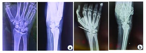 A And B Pre Operative X Rays Anterior Posterior And Lateral Download Scientific Diagram