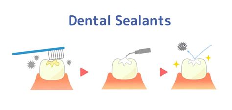 Everything You Need To Know About Dental Sealants Trafalgar Village Dental