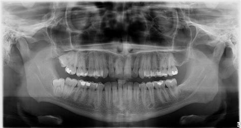 Odonto Ufpel Radiografias Panor Micas