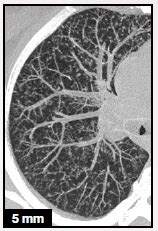 Principle of MIP and MINIP Reconstru | Imaging Atlas