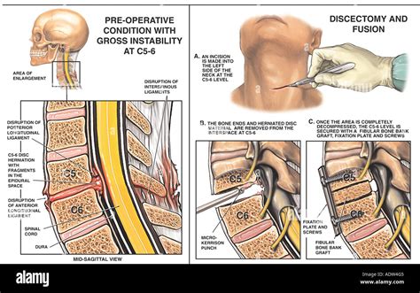 Discectomy Hi Res Stock Photography And Images Alamy