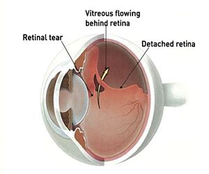 Detached and Torn Retina | Retina Specialists | Eye Surgery | Retina ...