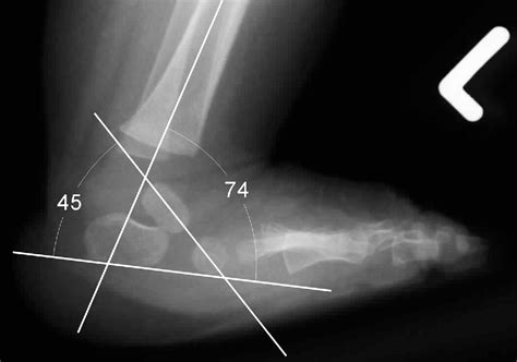 Figure From Radiographic Evaluation Of Idiopathic Clubfeet Undergoing