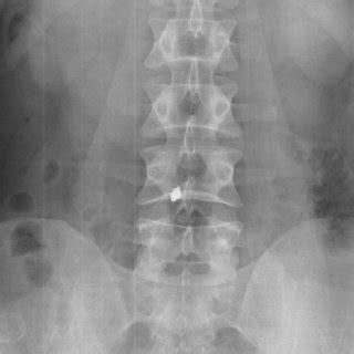 Lumbosacral Anteroposterior Radiographic View Of The Spine Showing The