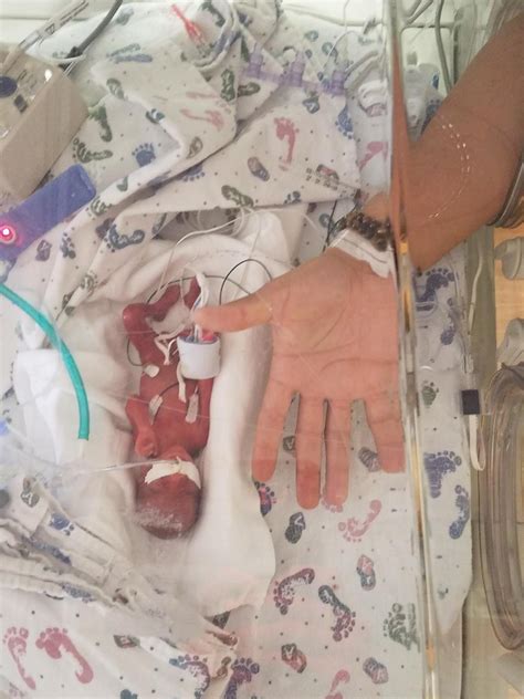 ‘miracle Baby Born At 23 Weeks Weighing 13 Ounces In Iowa