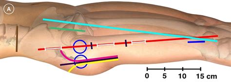 Cutaneous Anesthesia Of Hip Surgery Incisions With Iliohypogastric And Download Scientific