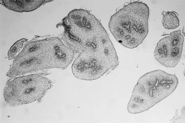 Segment of squamous papilloma of the esophagus showing finger-like ...