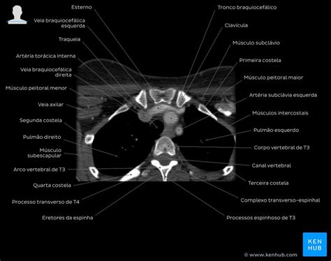 Imaginologia E Anatomia Radiológica Raios X Tc Rm Kenhub