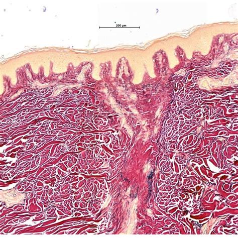 Elastic Staining Pattern In Scarring Alopecia The Elastic Van Gieson