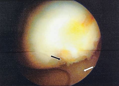 Knee subchondroplasty for management of subchondral bone cysts: a novel ...