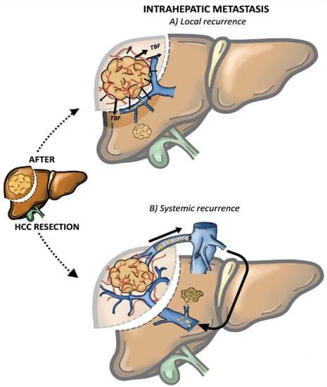 Surgical Strategies For Recurrent Hepatocellular Carcinoma After Resection Encyclopedia Mdpi