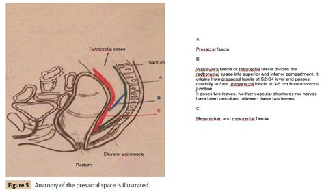 Tumours Of Retrorectal Space A Rare Entity Scarcely Known By General