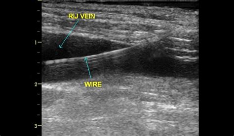 Ultrasound Guided Ijv Archives Emedical Academy