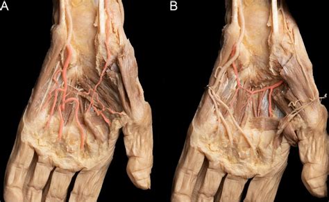 The Superficial Palmar Arch And Deep Palmar Arch Pattern The Palmaris