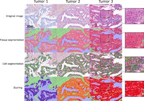 IHC Double Staining With Subsequent Automated Image Analysis Of HLA