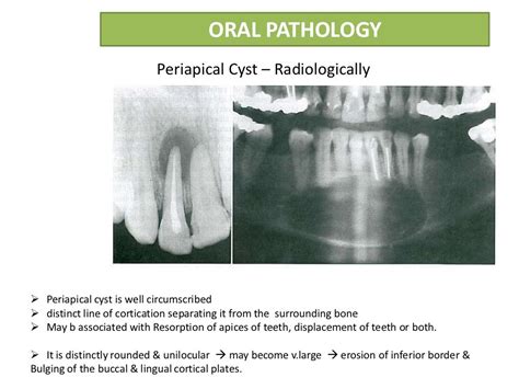 Radicular Cyst Or Periapical Cyst