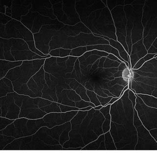 Late Phase Optos Fluorescein Angiography Image Taken Of Patient 1