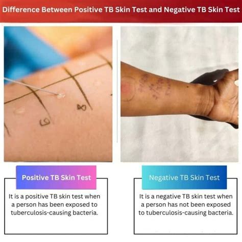 Positive Vs Negative Tb Skin Test Difference And Comparison