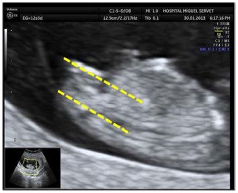 Ultrasound Measurement Learning Of Fetal Sex During The First Trimeste