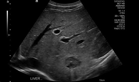 Echinococcus Multilocularis Liver