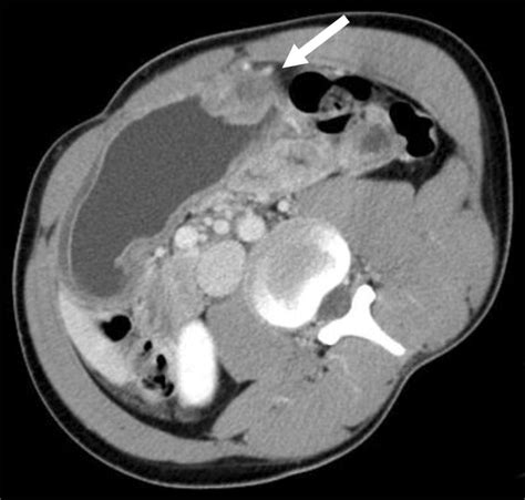 Abdominal Ct Shows Localized And Inhomogeneous Enhanced Submucosal Mass