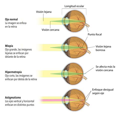 Cirurgia Refrativa A Laser De Martini Oftalmologia Santa Maria