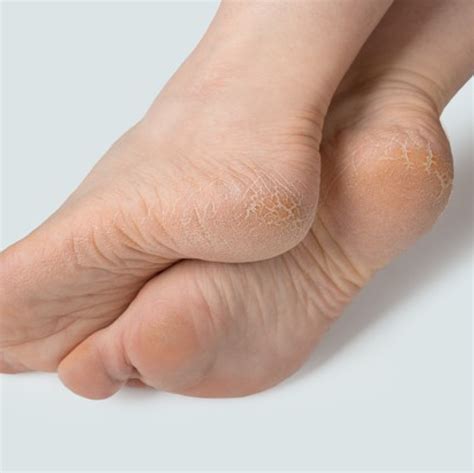 Cracked Skin On Foot Painful On Sale