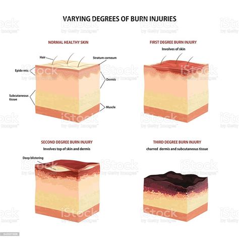 Vetores De Classificação De Queimadura De Pele E Mais Imagens De