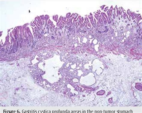 Figure From An Intramucosal Mucinous Adenocarcinoma Arising From A