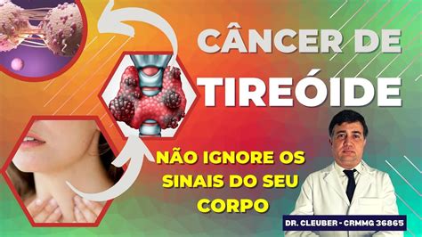 CÂNCER DE TIREÓIDE Conheça os Sintomas o Tratamento e a Cirurgia