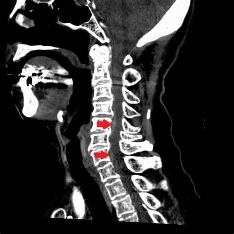 Spinal Subdural Hematoma