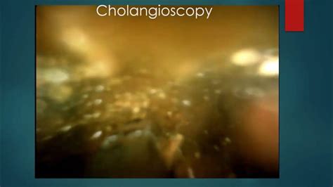 Cholangioscopy Ehl Gallstone In Bifurcation Bile Duct Youtube