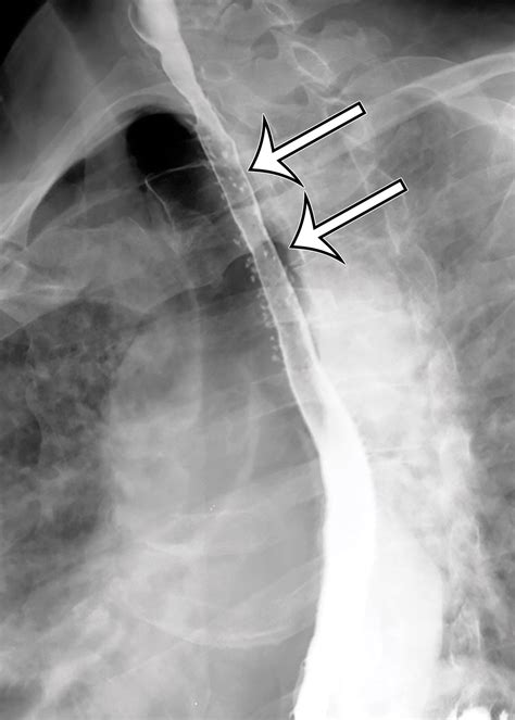 Role Of Multimodality Imaging In Gastroesophageal Reflux Disease And Its Complications With