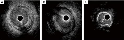 Plaque Categories A Fibrous Plaque B Lipid Rich C Calcific