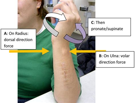 A Simple Distal Radioulnar Joint Orthosis Journal Of Hand Therapy