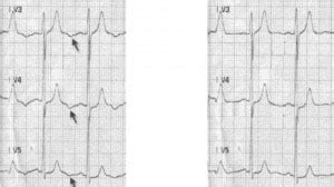 The U wave and the ECG: Don’t miss this | Resus