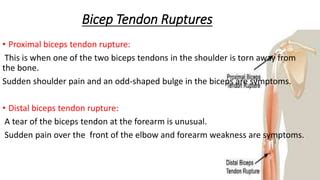 Biceps Rupture PPT