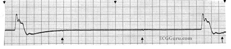 Ecg Basics Idioventricular Escape Rhythm Ecg Guru Instructor Resources