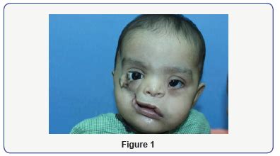 Median facial cleft syndrome – Telegraph