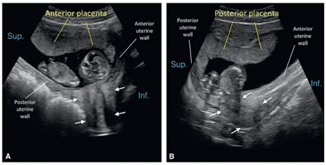 Placenta And Umbilical Cord Radiology Key