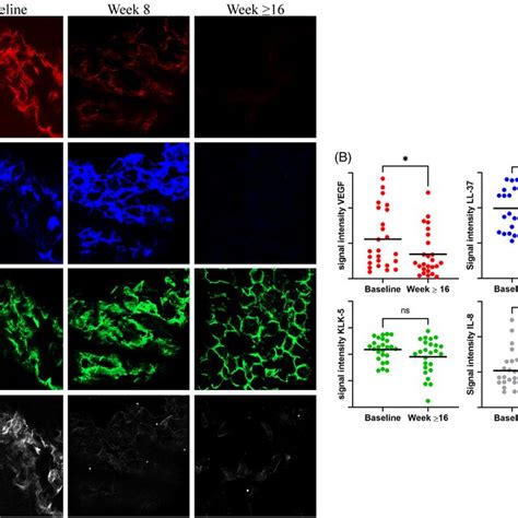 Ivermectin 1% topical cream ameliorates inflammation in rosacea. (A ...